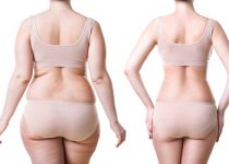 Liposuccion : femme avant et après liposuccion complète