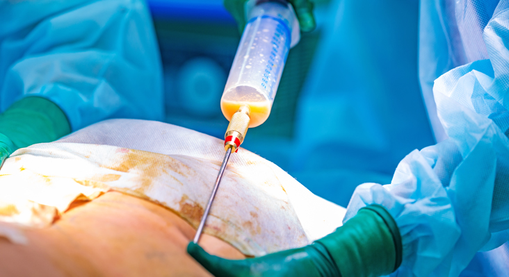 Liposuccion ventre patient sur une table opératoire